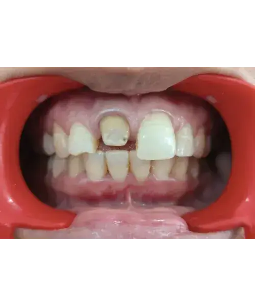 Smile transformation 1 — before treatment