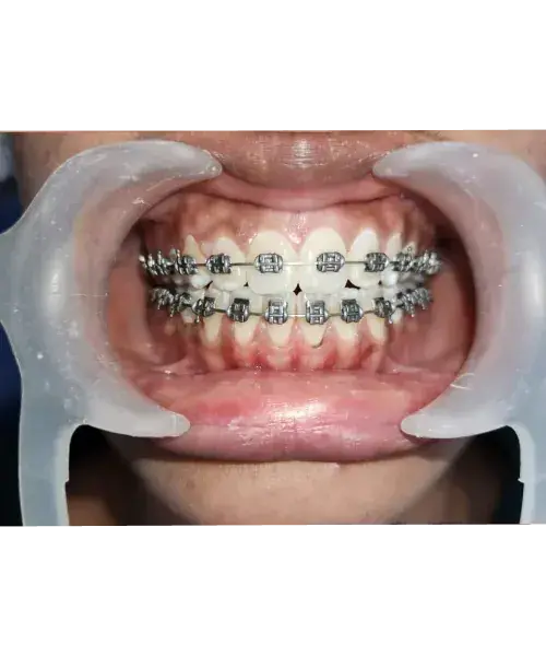 Smile transformation 7 — before treatment
