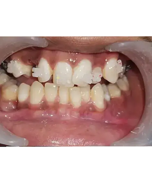 Smile transformation 8 — before treatment
