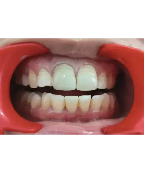 Smile transformation 1 — after treatment