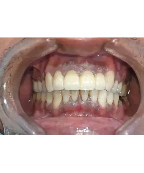 Smile transformation 2 — after treatment