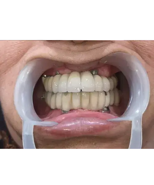 Smile transformation 3 — after treatment
