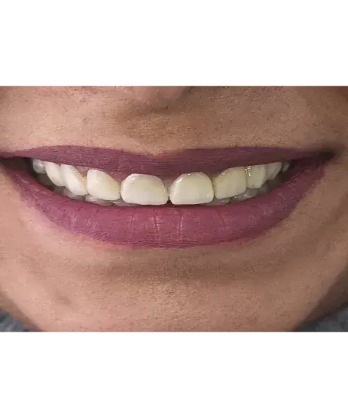 Smile transformation 6 — after treatment